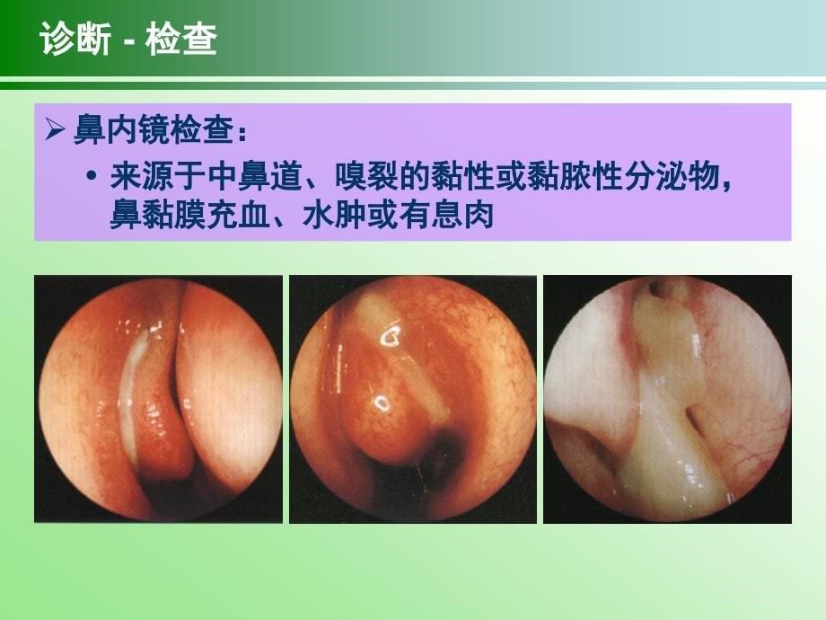 慢性鼻鼻窦炎治疗指南ppt课件 (2).ppt_第5页