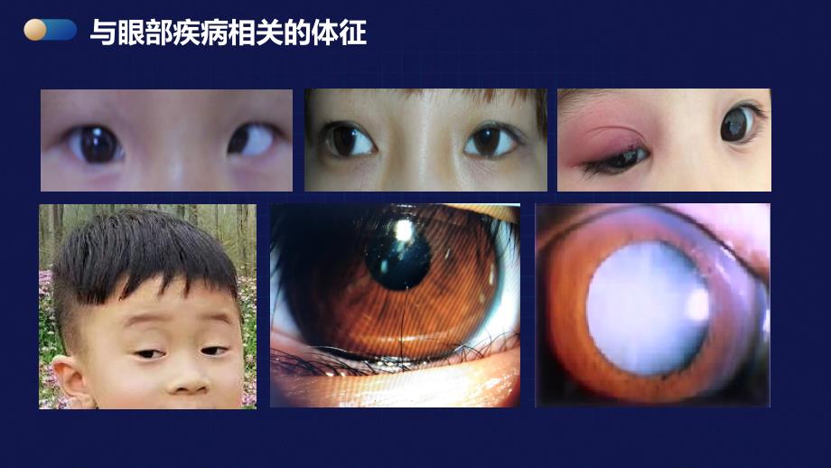 世界爱眼日——儿童常见眼病_第4页