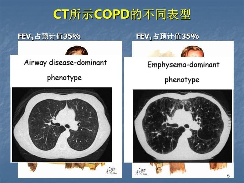 慢阻肺规范化诊治慢阻肺临床表型与治疗ppt课件.ppt_第5页