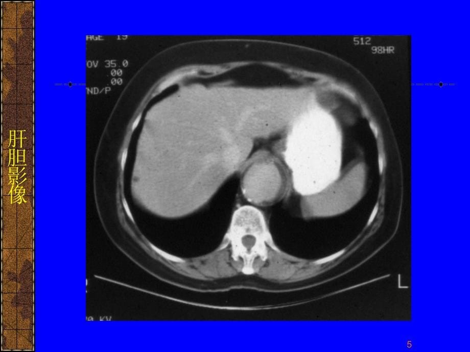 肝脏和胆道疾病CT诊断ppt课件.ppt_第5页