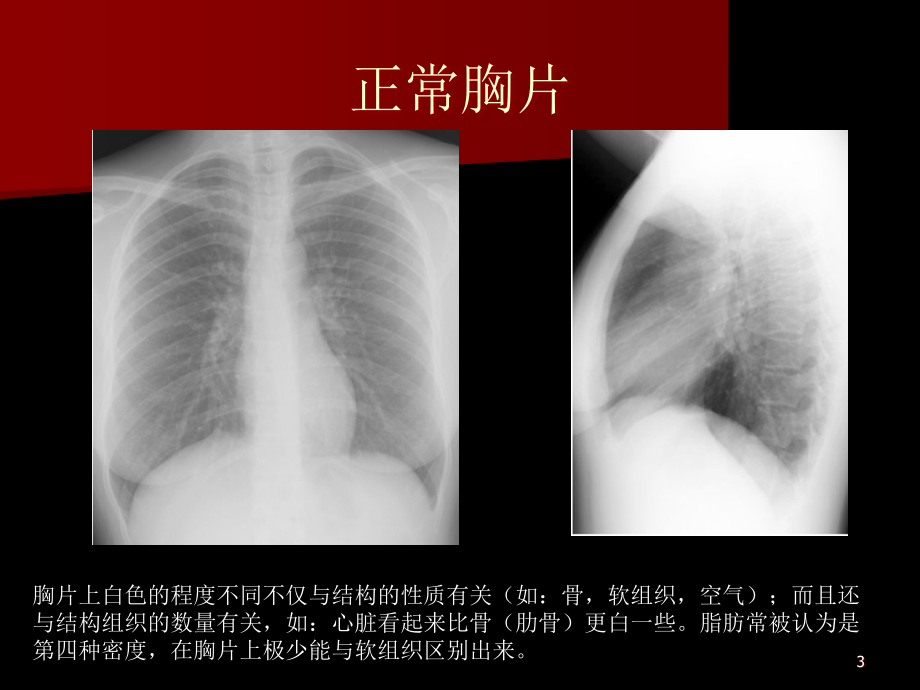 胸片入门及常见胸片的解读ppt课件.ppt_第3页