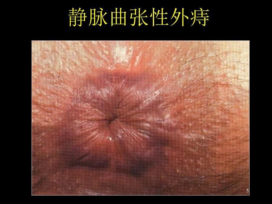 肛肠疾病小常识ppt课件.ppt_第5页