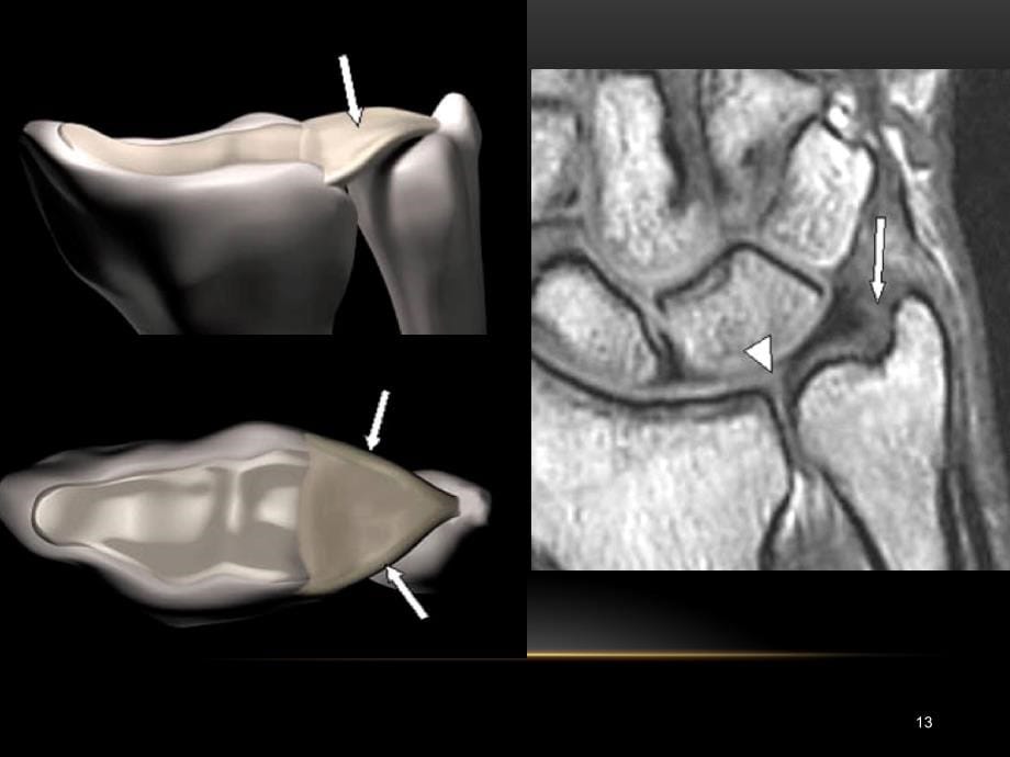 腕关节疾病的MRI诊断和解剖ppt课件.pptx_第5页