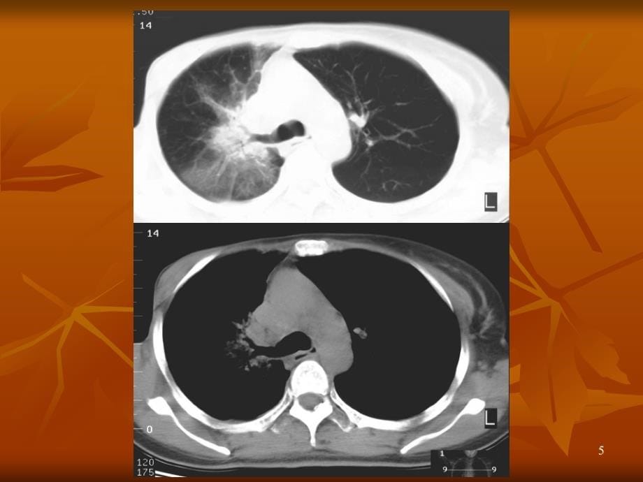 胸部正常CT断层解剖图片ppt课件.ppt_第5页