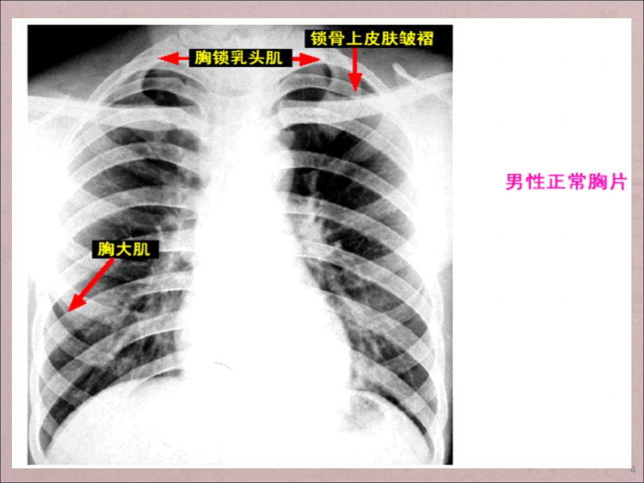 胸片阅读必看ppt课件.ppt_第4页