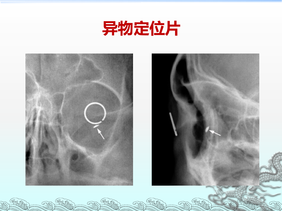 颅面部外伤影像学ppt课件.ppt_第2页