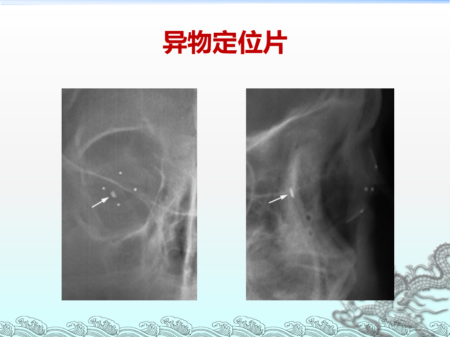 颅面部外伤影像学ppt课件.ppt_第3页