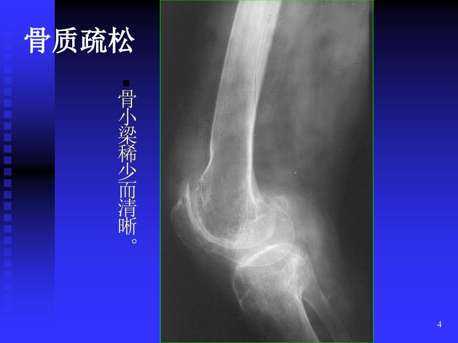 骨与关节ppt课件 (3).ppt_第4页