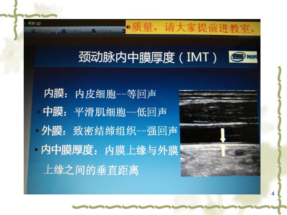 颈部血管超声诊断学习心得ppt课件.ppt_第4页