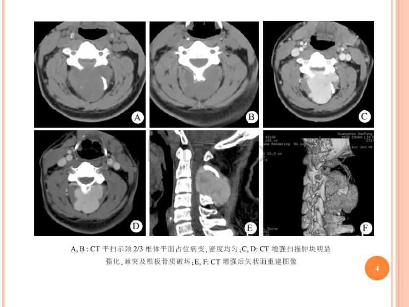颅内血管外皮细胞瘤的影像学表现ppt课件.ppt_第4页