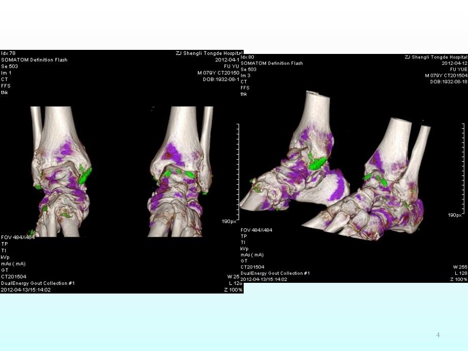 高尿酸血症和痛风ppt课件 (2).ppt_第4页