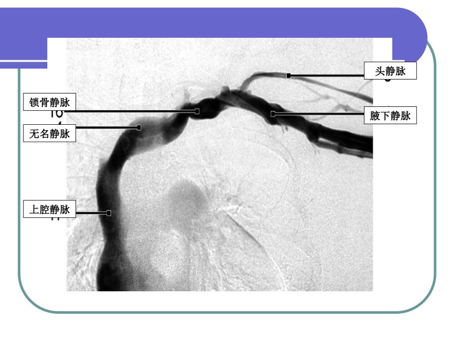 PICC管的X线定位(1)_第3页