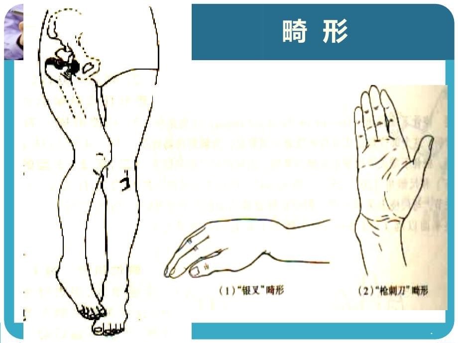 《四肢骨折经典》PPT课件.ppt_第5页