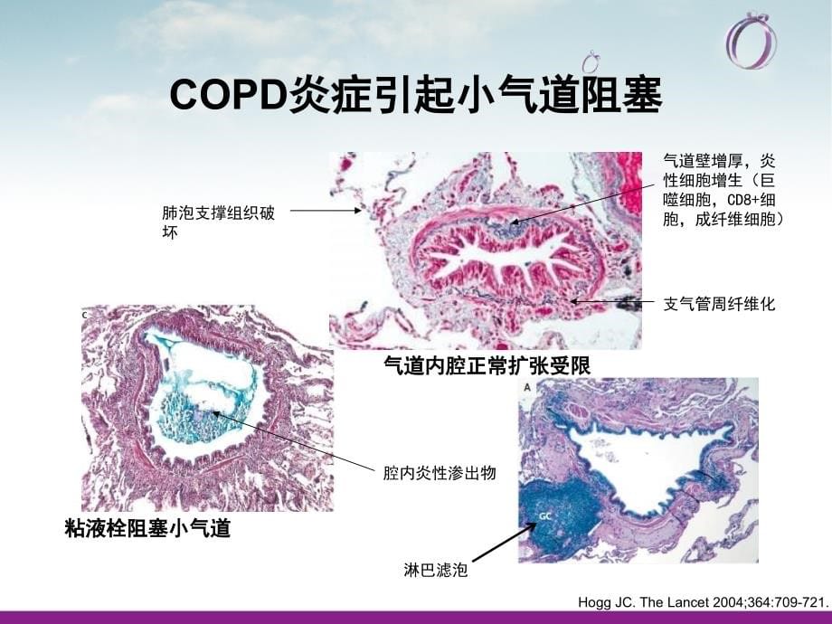 COPD疾病现状_第5页