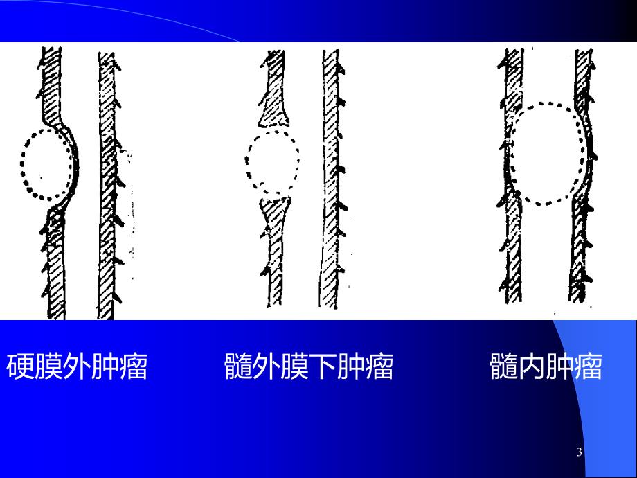 椎管内肿瘤医学医药精品精品PPT课件.ppt_第3页