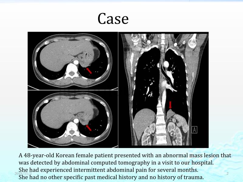 肺隔离症影像学 诊断PPT课件.ppt_第2页