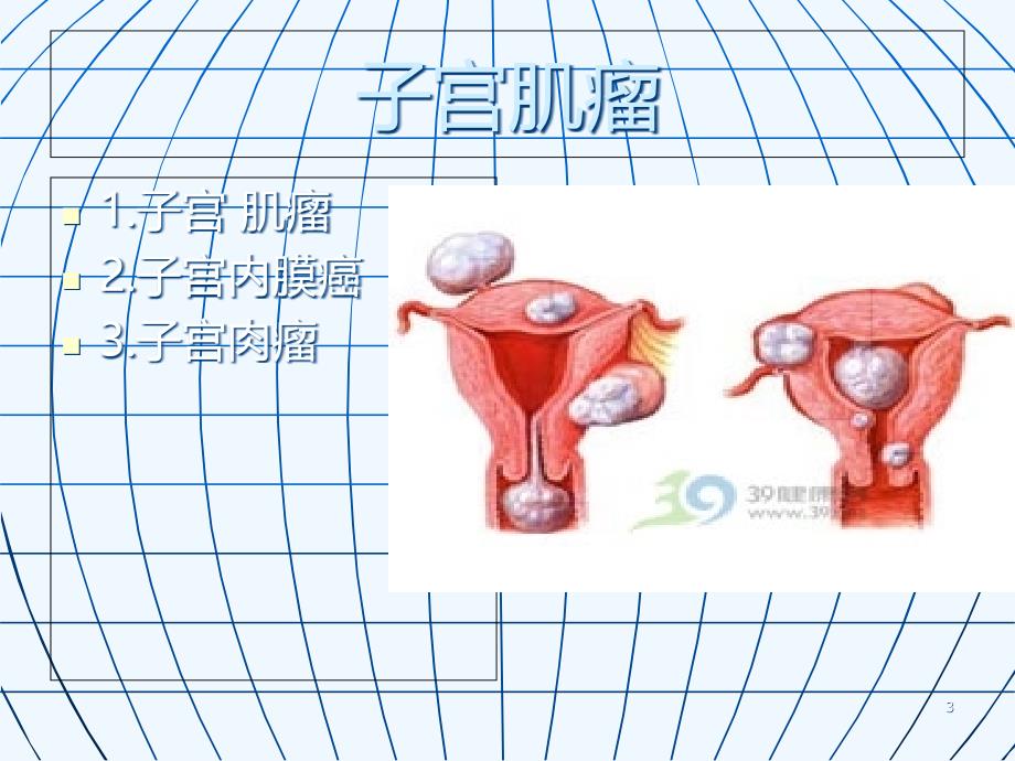 子宫肌瘤病人术后的护理PPT课件.ppt_第3页