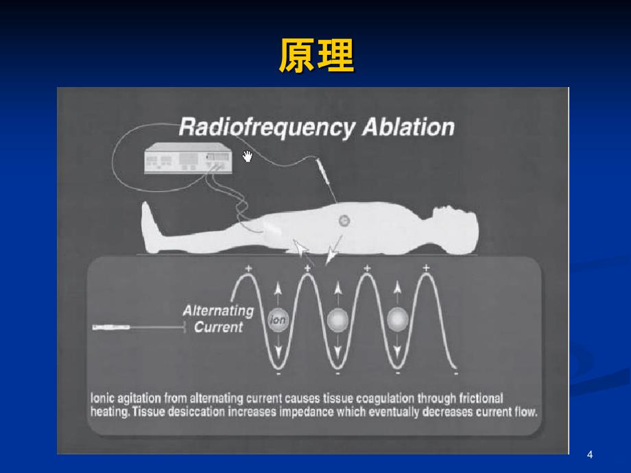 射频消融治疗肝细胞肝癌PPT课件.ppt_第4页