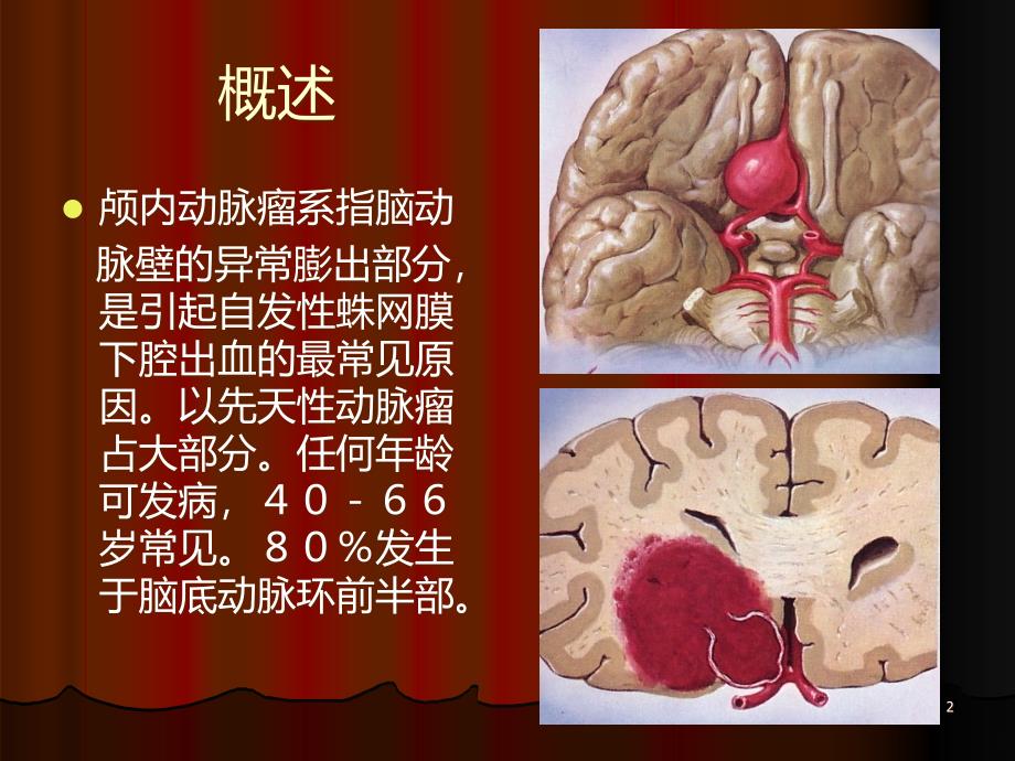 大脑前动脉动脉瘤 用PPT课件.ppt_第2页