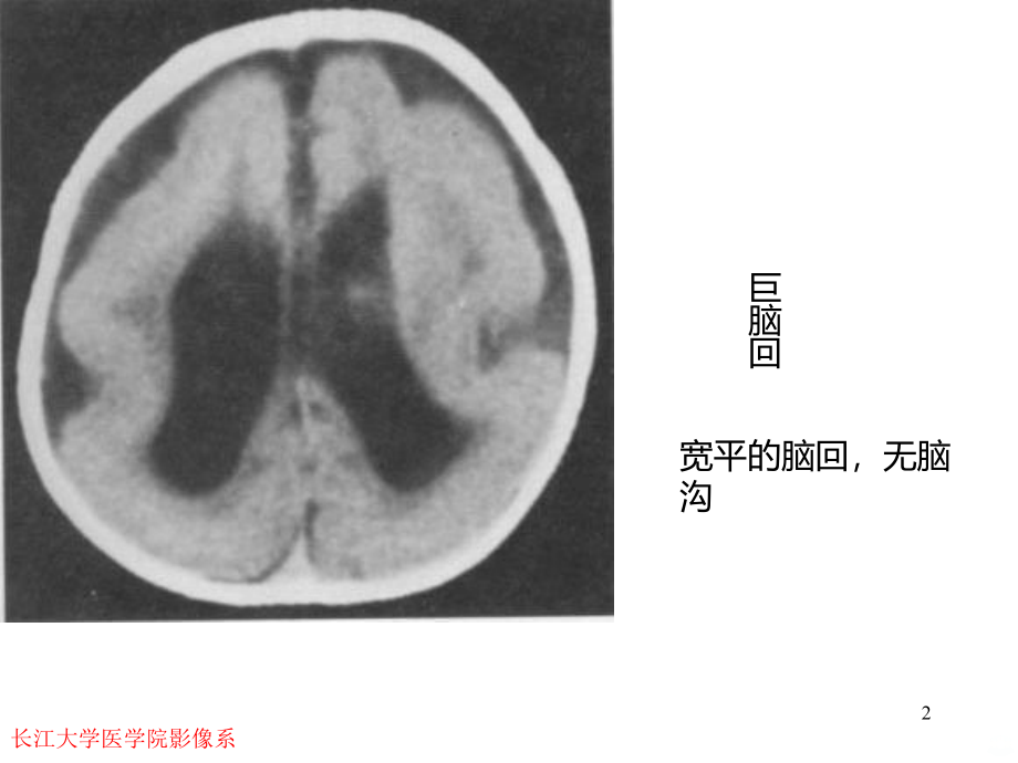 畸形与脑血管精品PPT课件.ppt_第2页