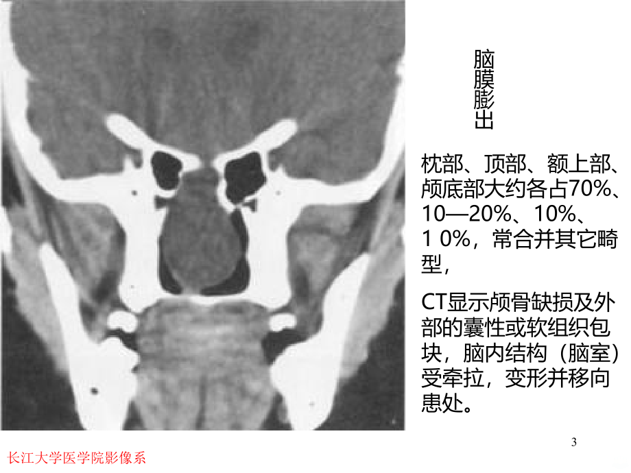 畸形与脑血管精品PPT课件.ppt_第3页