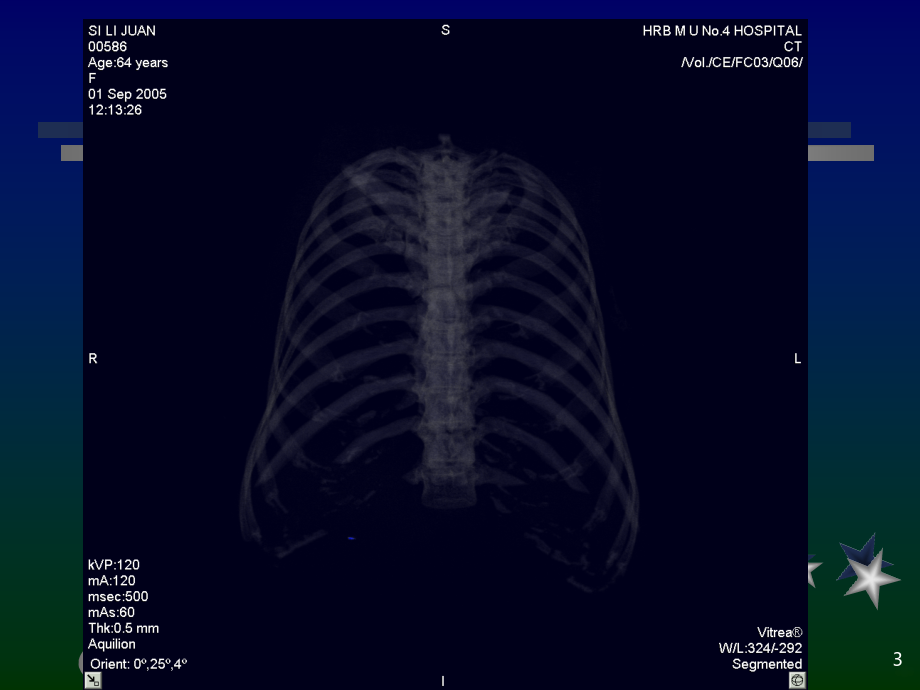 胸部疾病影像诊断 - 副本PPT课件.ppt_第3页