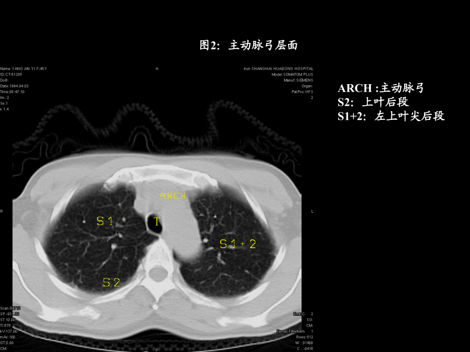 胸部肺段划分CT_第2页