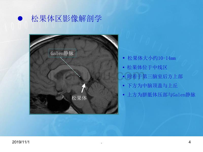 松果体区病变影像学表现精品课件.ppt_第4页