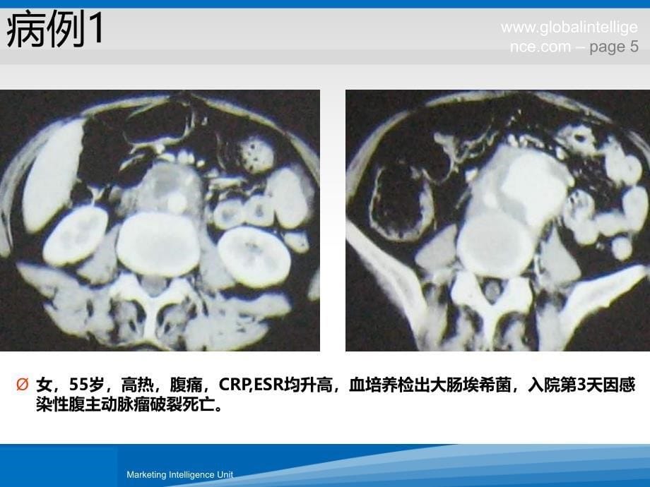 感染性腹主动脉瘤诊疗体会PPT课件.ppt_第5页