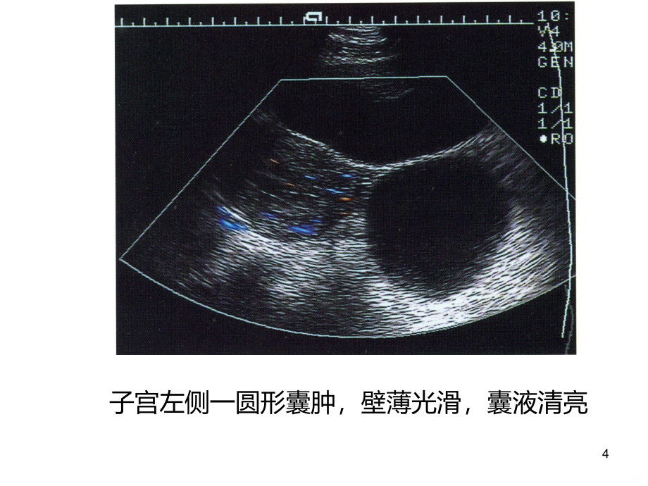 卵巢疾病的超声鉴别诊断PPT课件.ppt_第4页