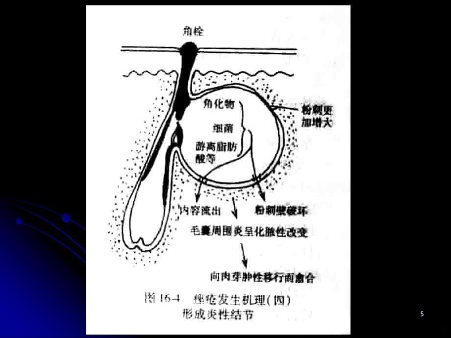 治疗痤疮药PPT课件.ppt_第5页