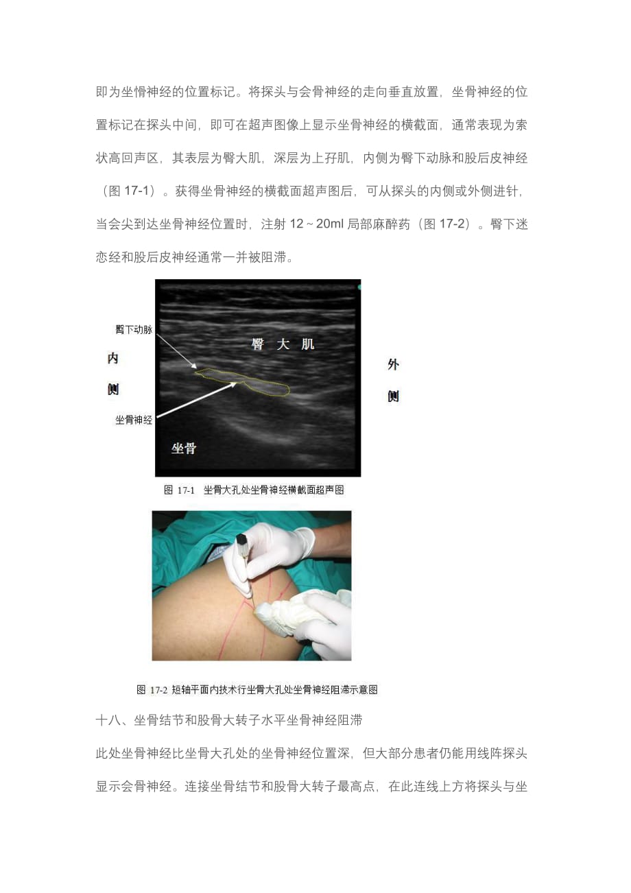 骶丛神经阻滞_第2页