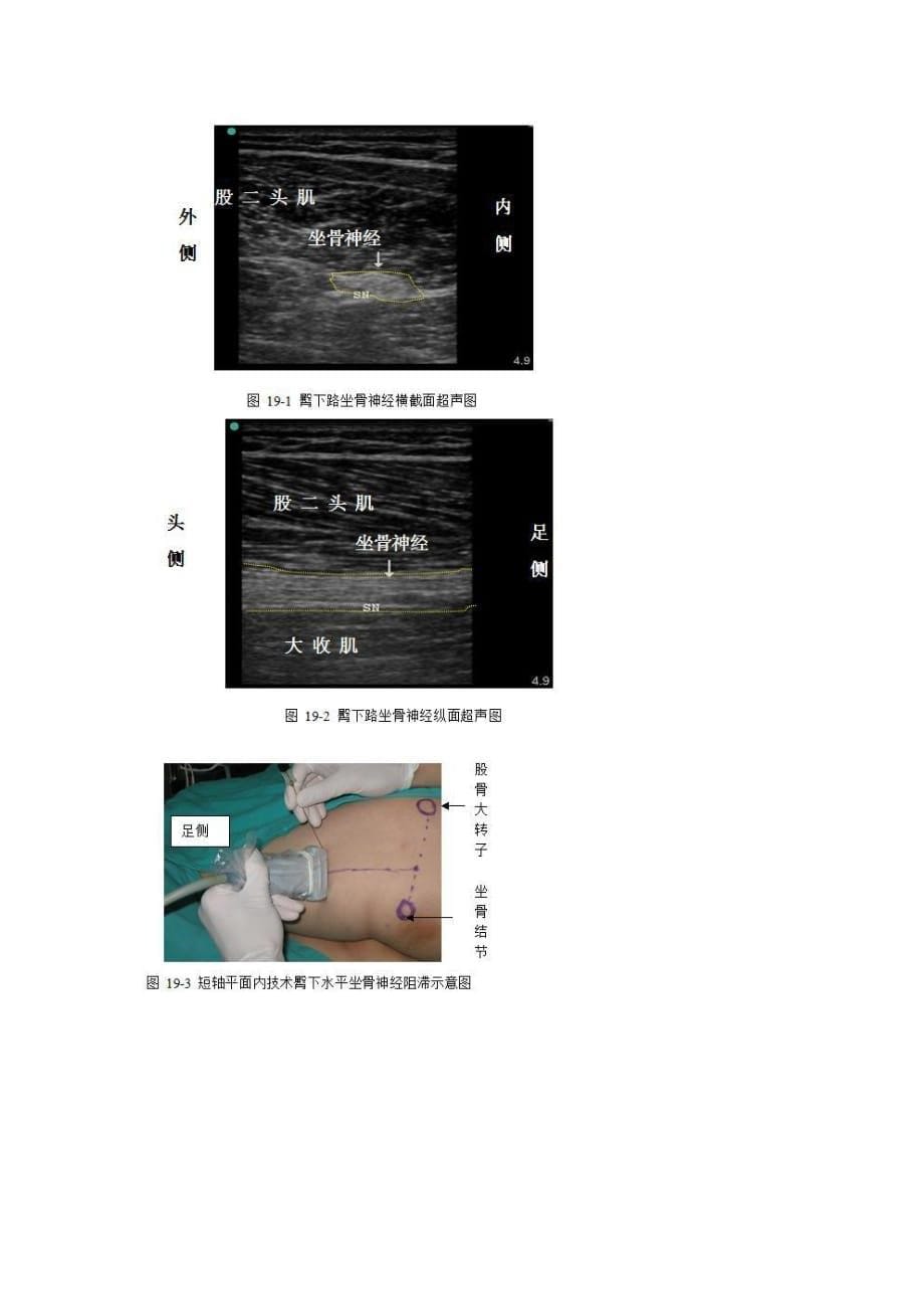骶丛神经阻滞_第5页