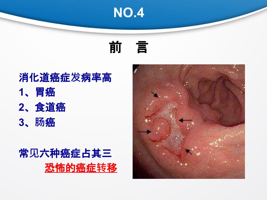 恐怖的胃癌转移_第1页