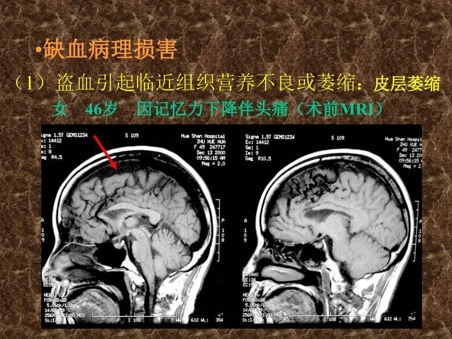 盗血对中枢神经系统影响的临床研究ppt课件.ppt_第5页