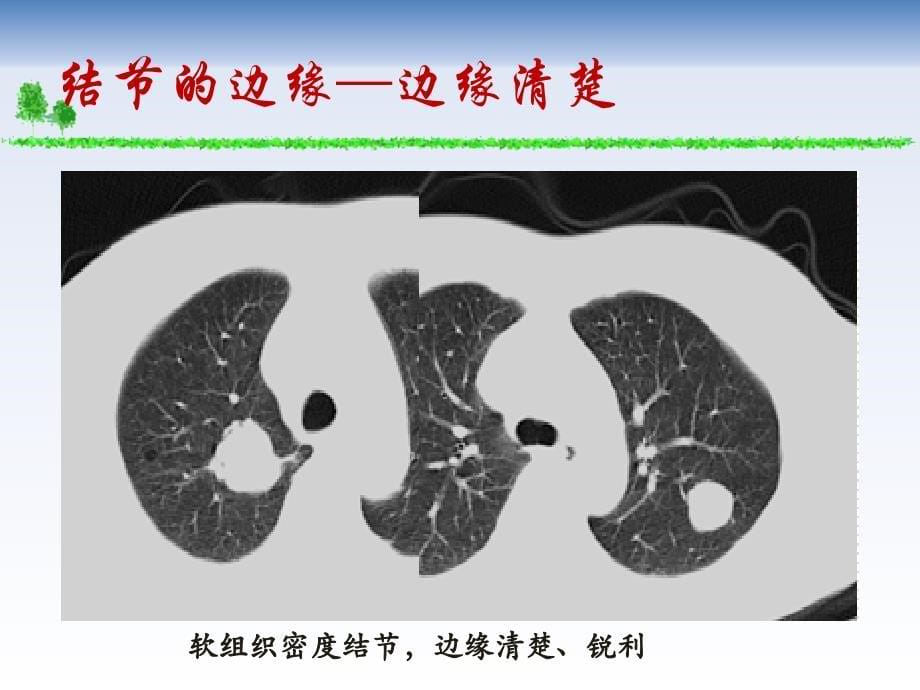 肺结节的CT征象分析PPT课件.ppt_第5页