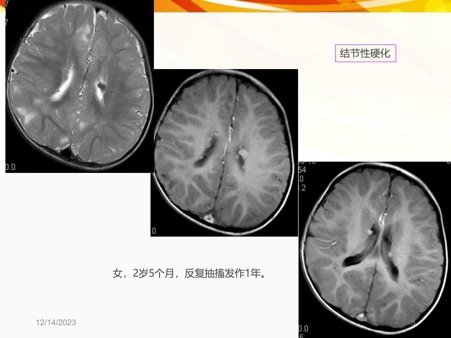 医学影像癫痫的MRI及MRSPPT课件.ppt_第5页