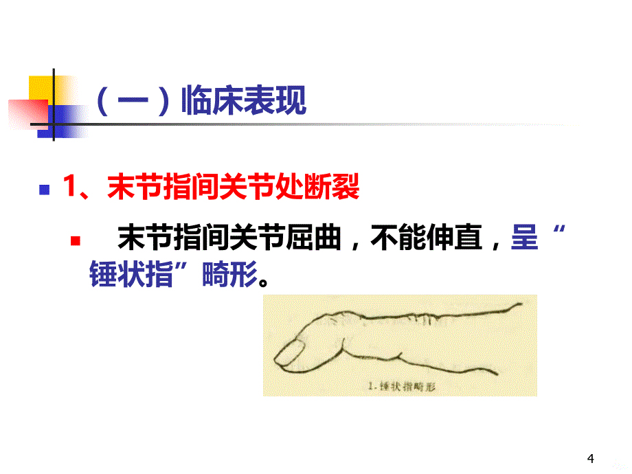 指伸屈肌腱断裂PPT课件.ppt_第4页