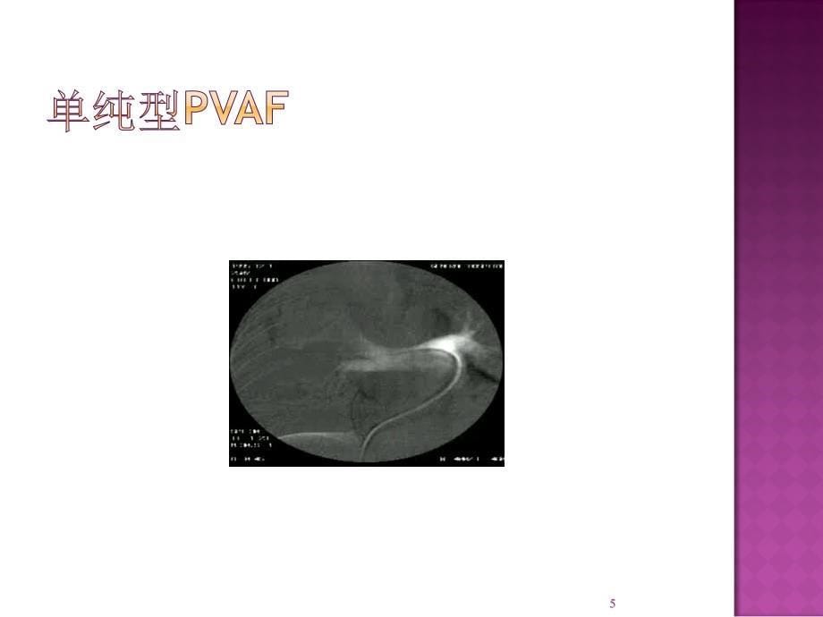 肺动静脉瘘的影像诊断PPT课件.ppt_第5页