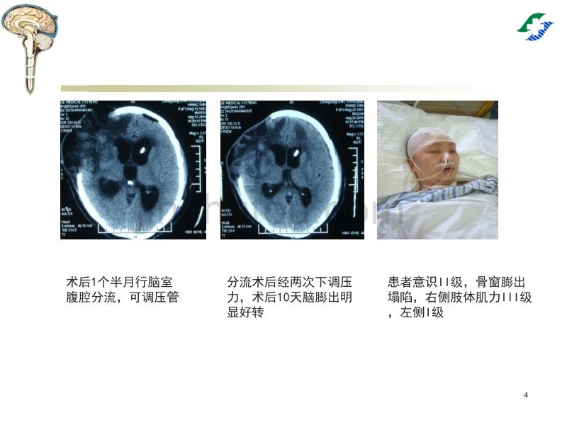 腰大池穿刺置管引流术专业ppt课件.ppt_第4页