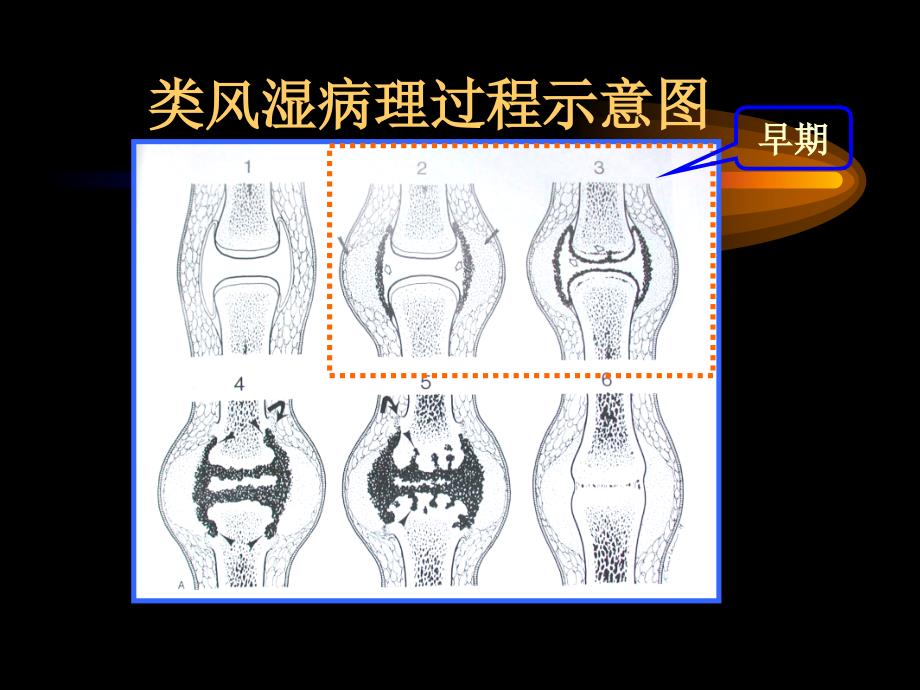 类风湿性关节炎-(2)_第4页