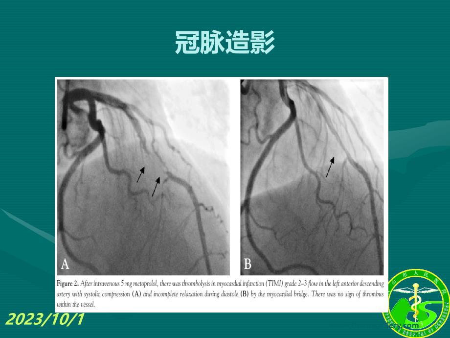 血管痉挛性心绞痛(变异型心绞痛)PPT课件.ppt_第3页