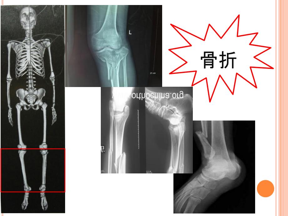 胫腓骨骨折复位术的手术配合PPT课件.ppt_第3页