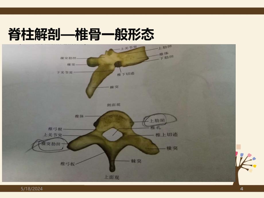 脊柱侧弯矫形术手术配合方法PPT课件.ppt_第4页