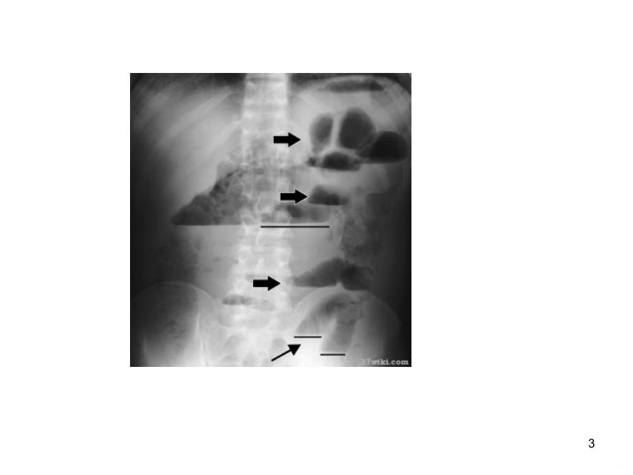 肠梗阻、结肠、直肠癌病人护理简述PPT课件.ppt_第3页