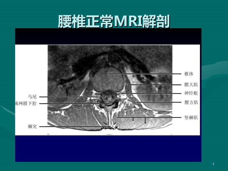 腰椎间盘的MRI诊断PPT课件.ppt_第4页