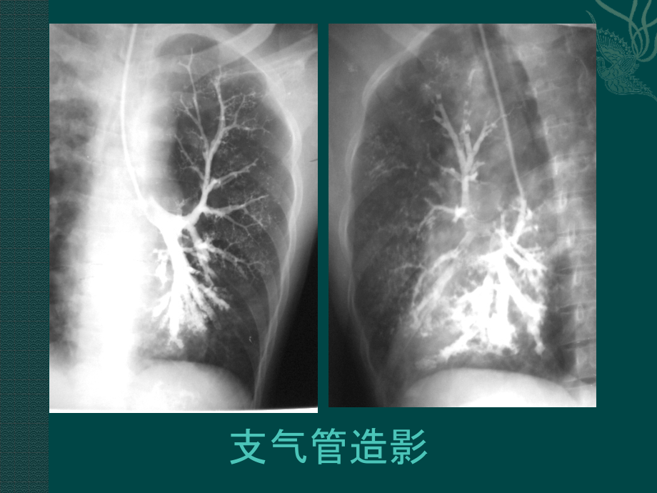 肺部、纵膈、心血管、乳腺—临床见习（142页）_第3页