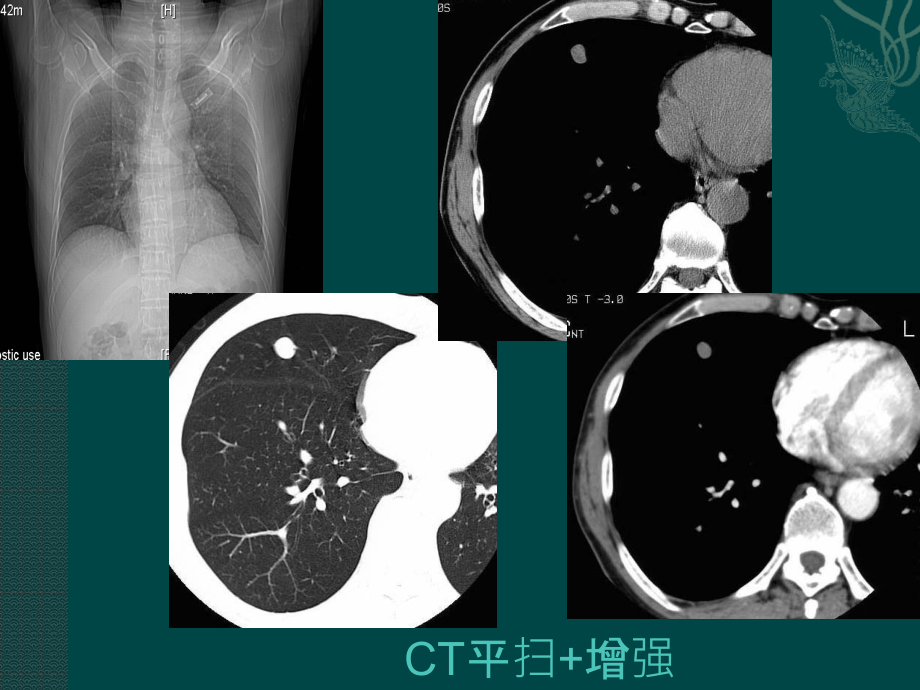 肺部、纵膈、心血管、乳腺—临床见习（142页）_第4页