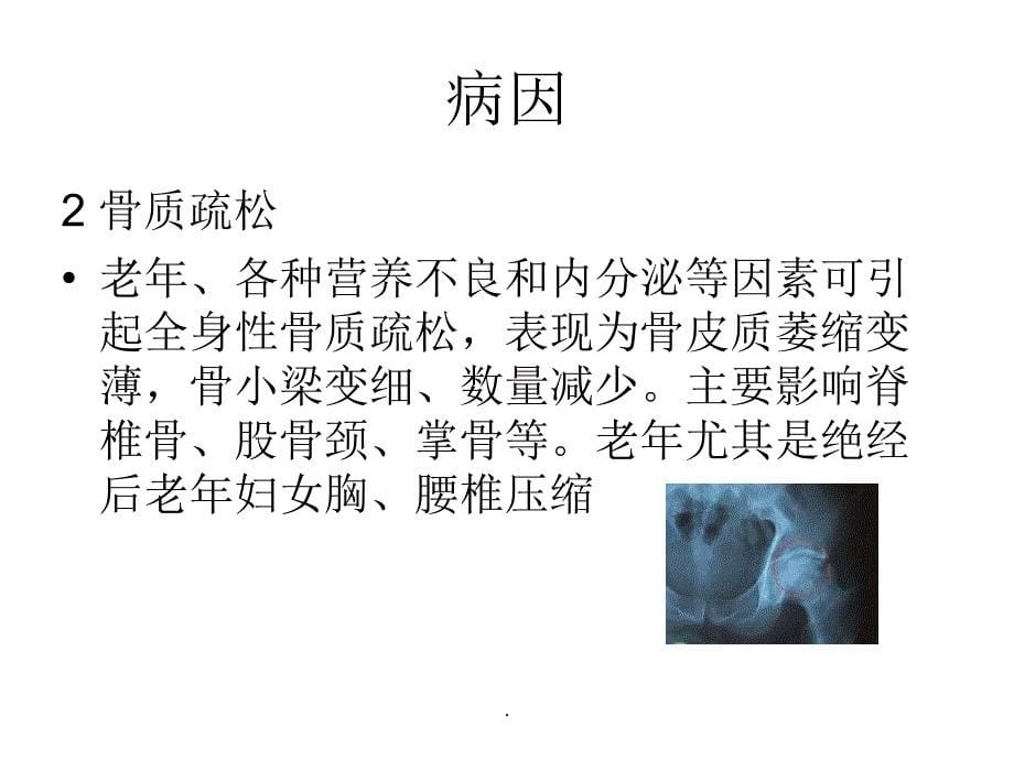 病理骨折及骨质疏松专业课件PPT.ppt_第5页