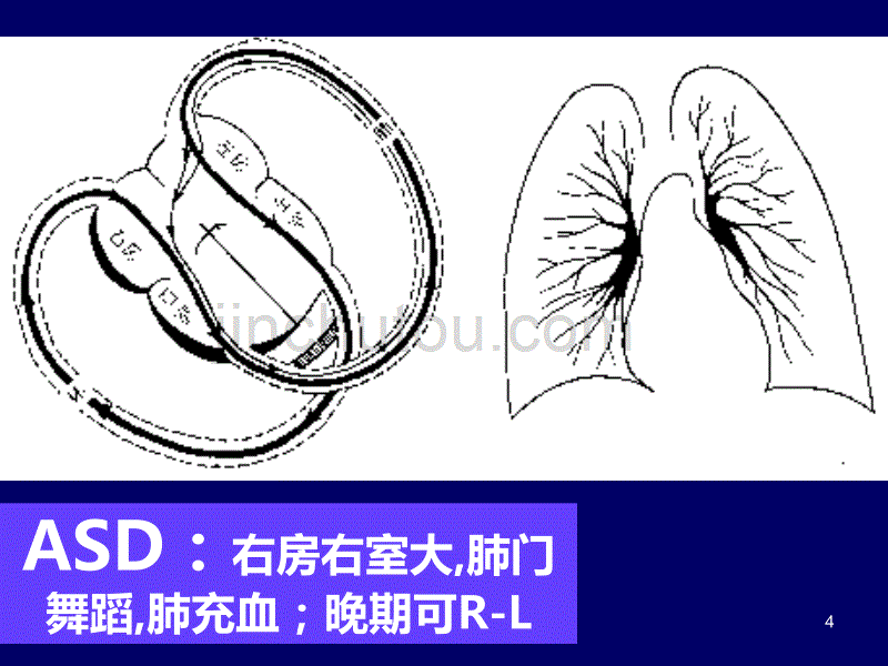 心血管先心(X线)PPT课件.ppt_第4页